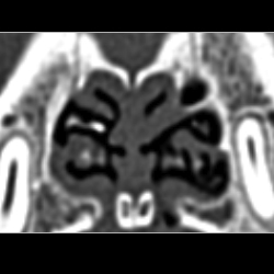 Abnormal growth of the turbinates at the cranial nasal cavity in a pug