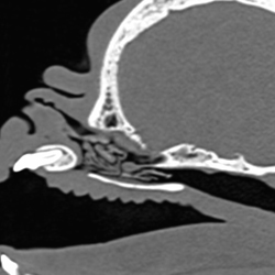 Severely obstructed nasal cavity and nasopharyngeal turbinates