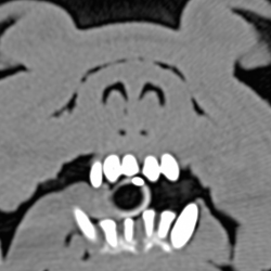 Collapse of the alar folds (second stenosis)