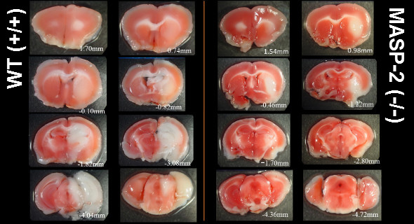 Targeting the complement component MASP-2 significantly limits tissue loss following transient cerebral ischaemia (i.e. a model of stroke)