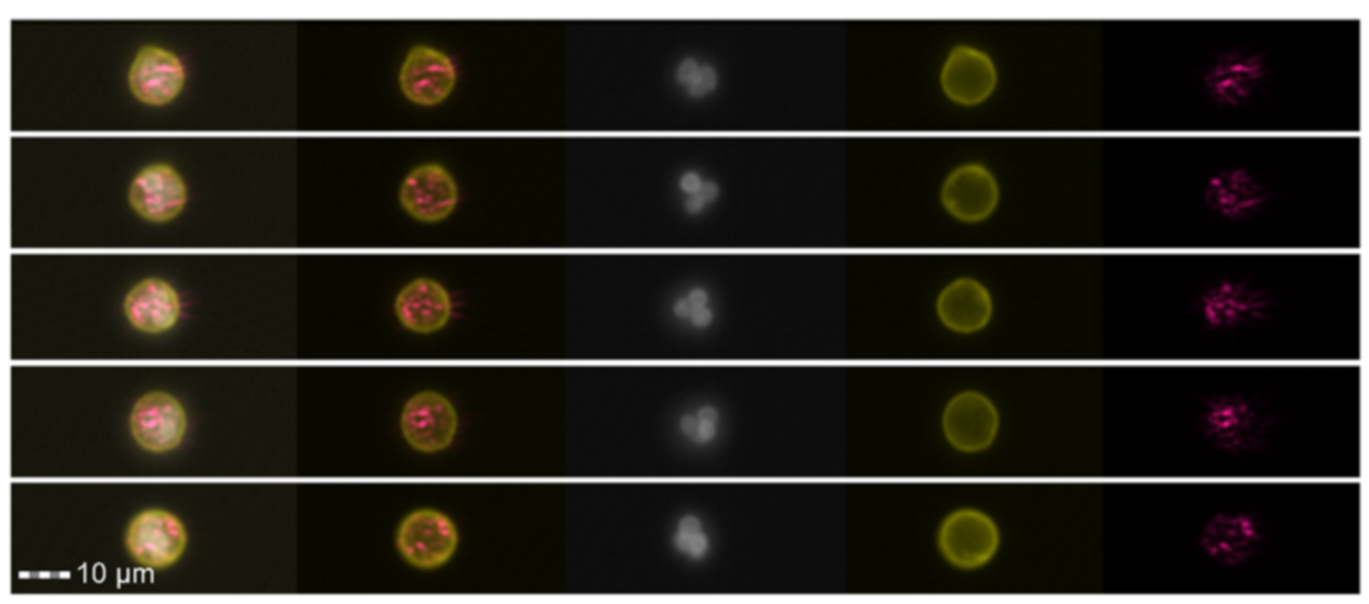 human neutrophils bearing titanium particles