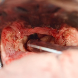 Soft palate shortened and tonsils were partially resected