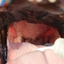 Elongated soft palate & enlarged tonsils