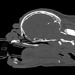 Thickened and elongated soft palate