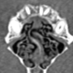 Septal deviation of a pug