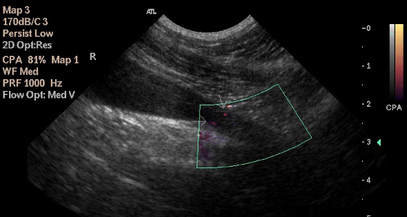 Doppler ultrasound image of bilateral ectopic ureters in a clinically normal bitch