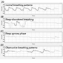 Continuous flow trace (A-B-C-D) indicates sleep-disordered breathing