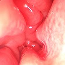 Hypertrophic nasal turbinates obstruct the nasal cavity