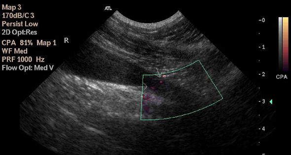 Doppler ultrasound image of bilateral ectopic ureters in a clinically normal bitch Doppler ultrasound image of bilateral ectopic ureters in a clinically normal bitch