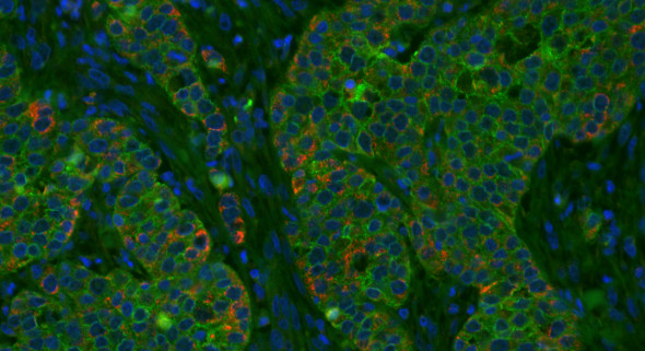 Immunofluorescence to assess expression of a protein implicated in tumour development